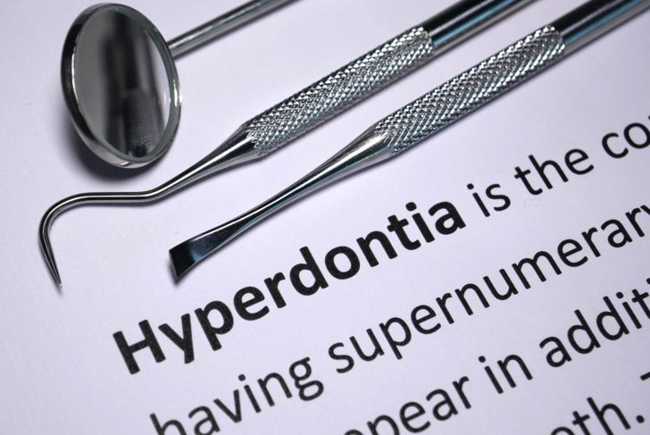Hyperdontia: Are Extra Teeth a Problem?