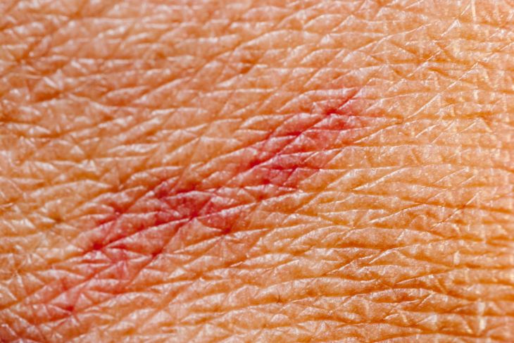 Identifying and Dealing with Skin Ulcers
