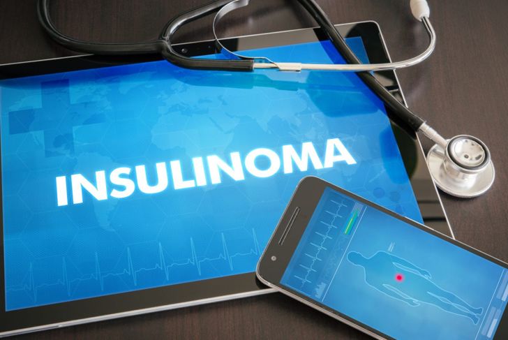 Insulinomas: Benign Pancreatic Tumors