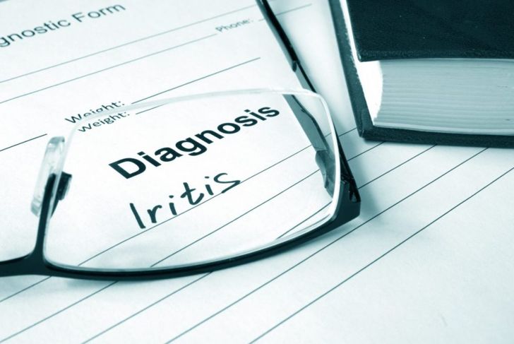 Iritis: Inflammation of the Iris