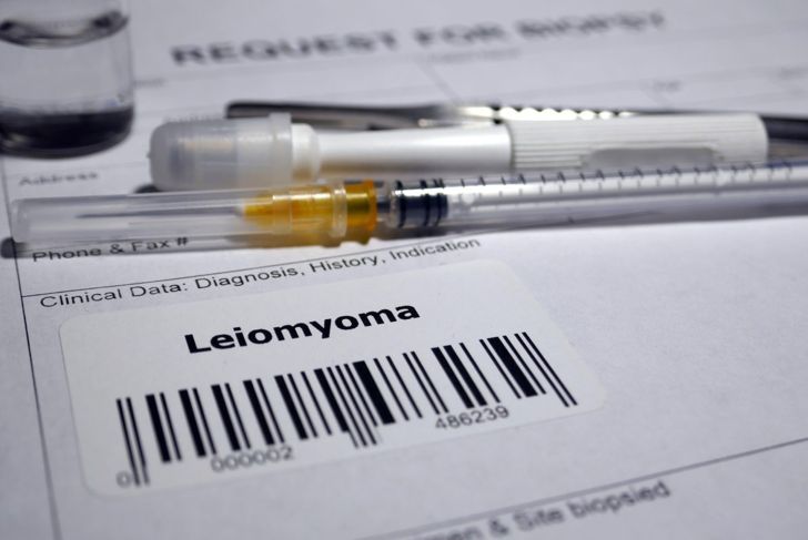 Leiomyoma: Smooth Muscle Tumors