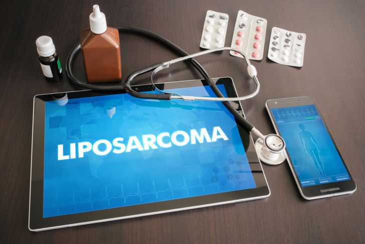 Lipoma: 10 Causes, Symptoms, and Treatments