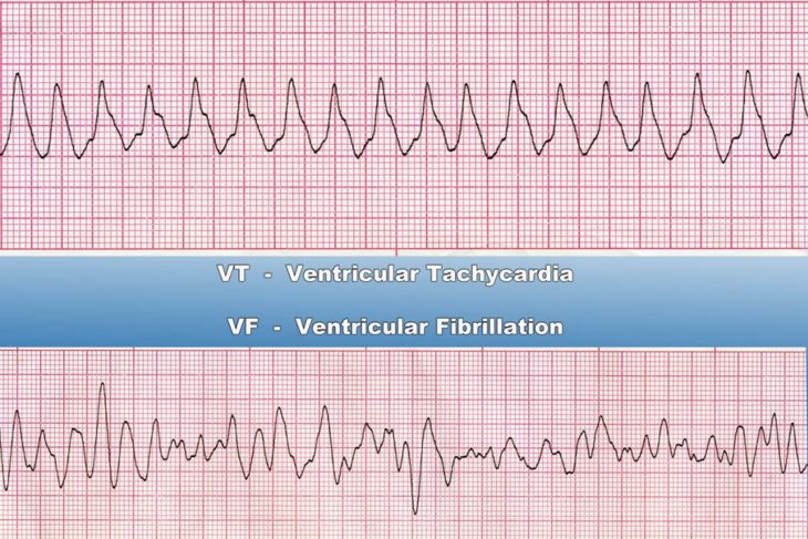 Long QT Syndrome Can Cause Arrhythmia