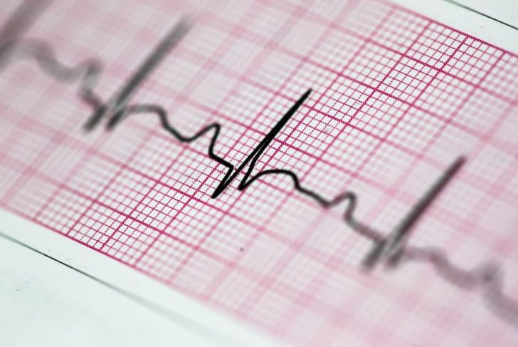Long QT Syndrome Can Cause Arrhythmia