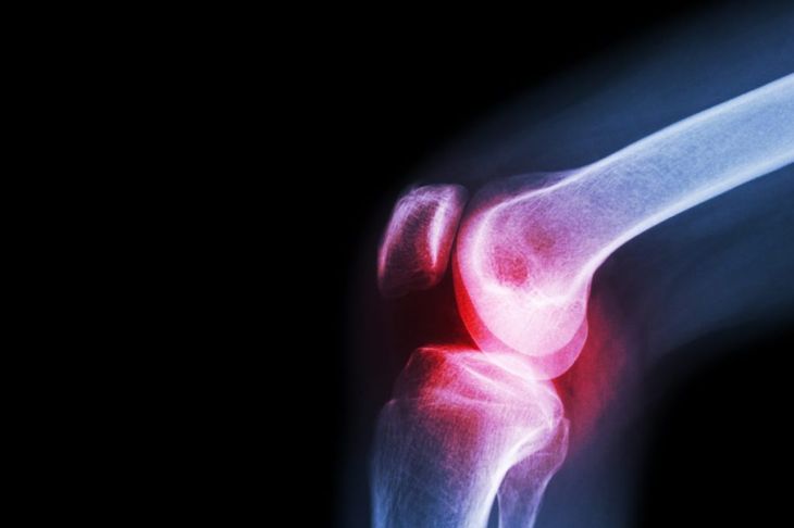 Osteoarthritis Signs and Symptoms