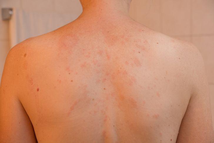 Pityriasis Rosea: 10 Symptoms and Treatments