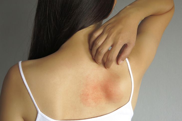 Pityriasis Rosea: 10 Symptoms and Treatments