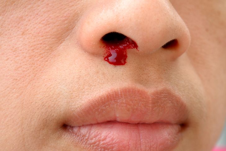 Preventing and Stopping Nosebleeds