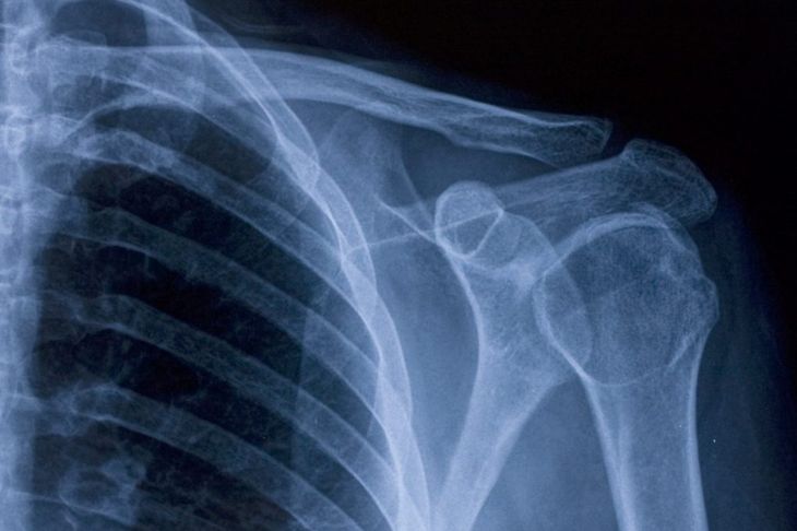 Rare Thoracic Outlet Syndrome Causes Arm and Shoulder Weakness