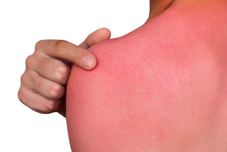 Recognizing and Treating a Sun Allergy