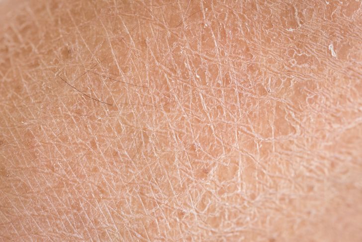 Scaly, Dry Skin? Learn About Ichthyosis