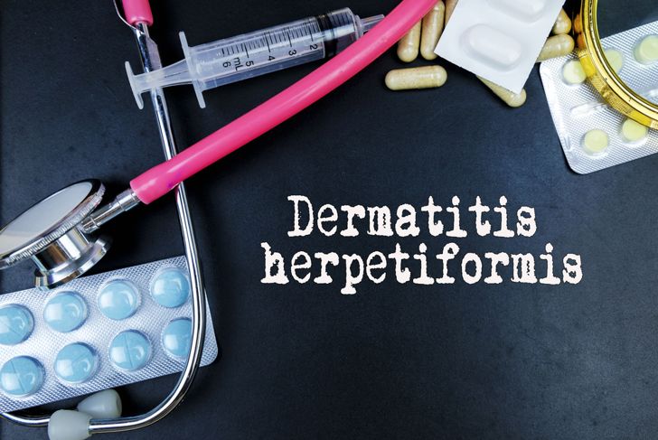 Sensitive to Gluten? 10 FAQs About Dermatitis Herpetiformis
