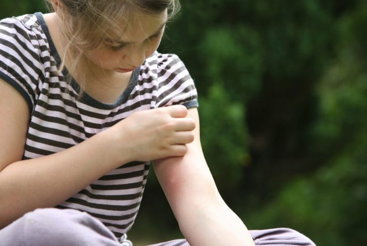 Severe Mosquito Bites: Skeeter Syndrome