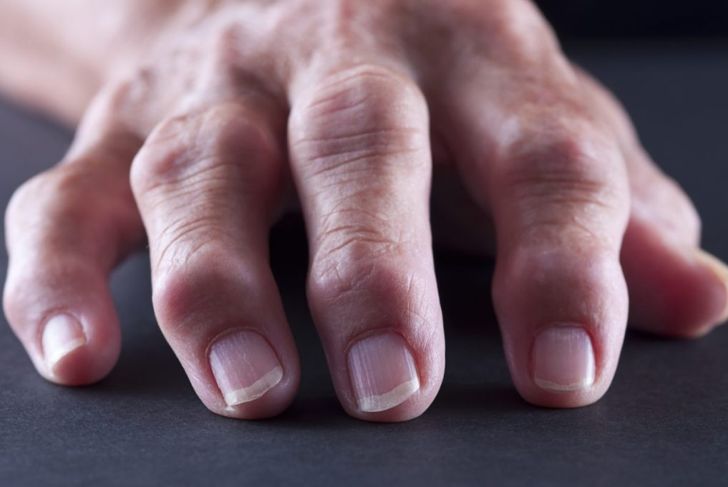 Short and Long Term Complications of Gout