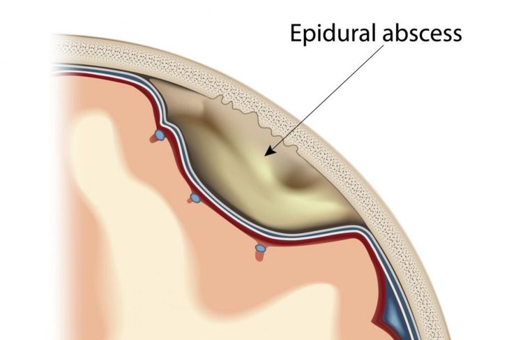 Signs and Causes of Epidural Hematoma