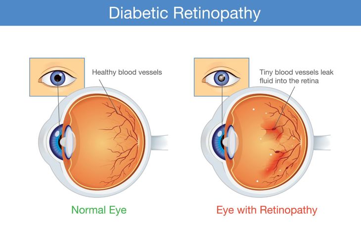 Signs, Causes, and Treatments of Diabetic Retinopathy