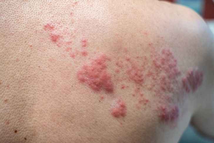 Signs, Causes, and Treatments of Morphea