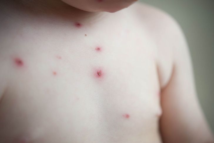 Signs of Chickenpox