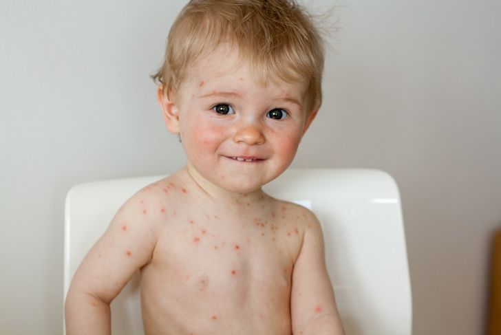 Signs of Chickenpox