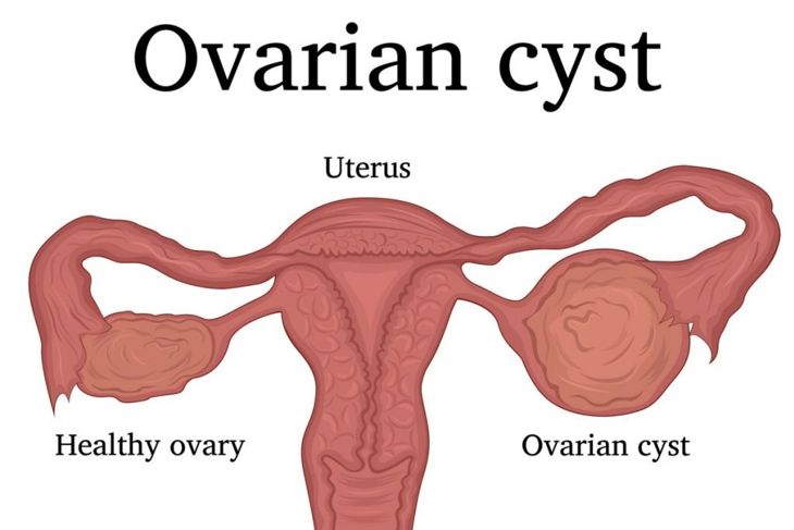 Symptoms and Causes of Inflamed Ovaries