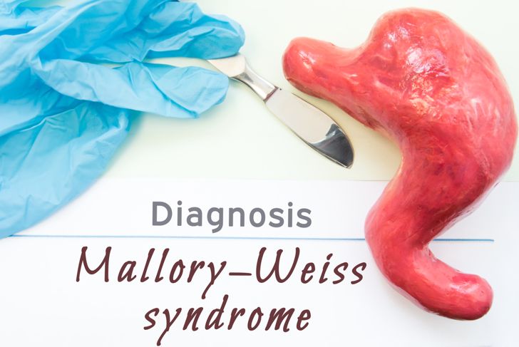Symptoms and Causes of Mallory-Weiss Syndrome