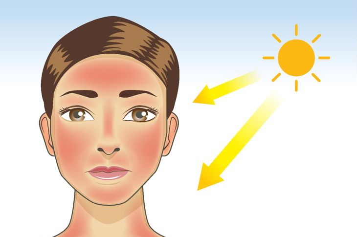 Symptoms and Causes of Polymorphic Light Eruption