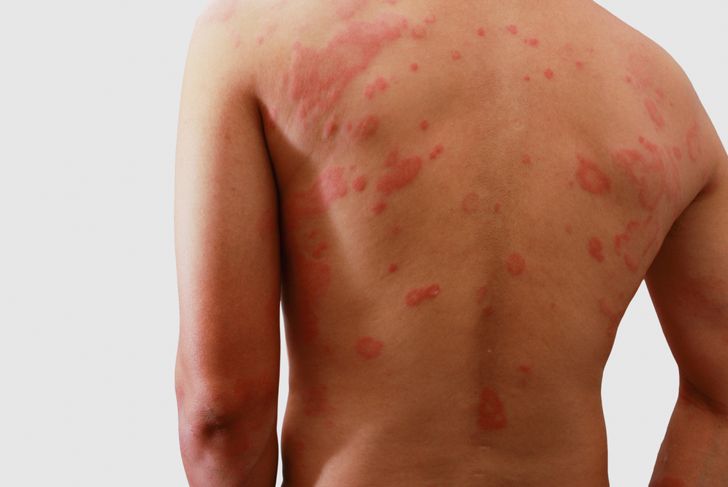 Symptoms and Causes of Polymorphic Light Eruption