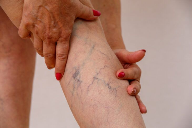 Symptoms and Causes of Spider Veins
