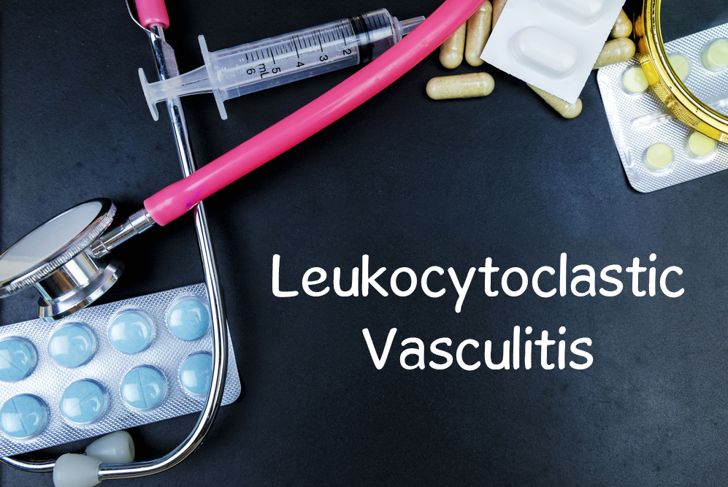 Symptoms and Risks of Leukocytoclastic Vasculitis