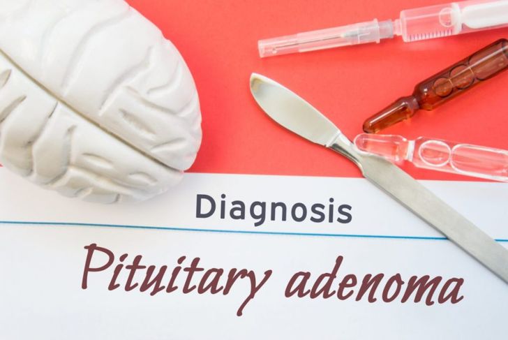 Symptoms and Treatments of Pituitary Tumors