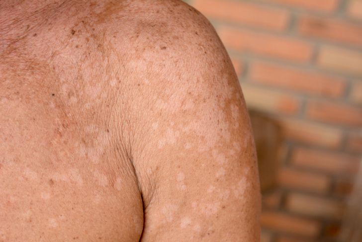 Symptoms and Treatments of Pityriasis Versicolor