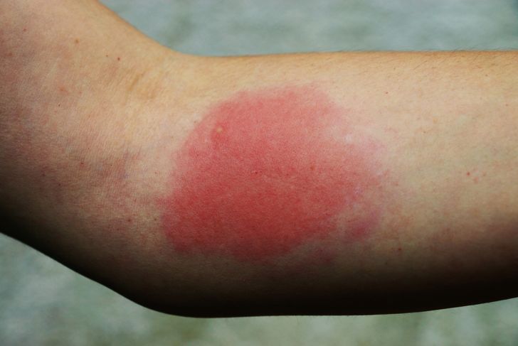 Symptoms and Treatments of Pruritus