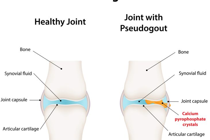 Symptoms and Treatments of Pseudogout
