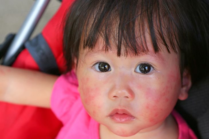 Symptoms of Fifth Disease in Children and Adults