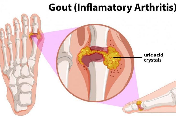Symptoms of Gout