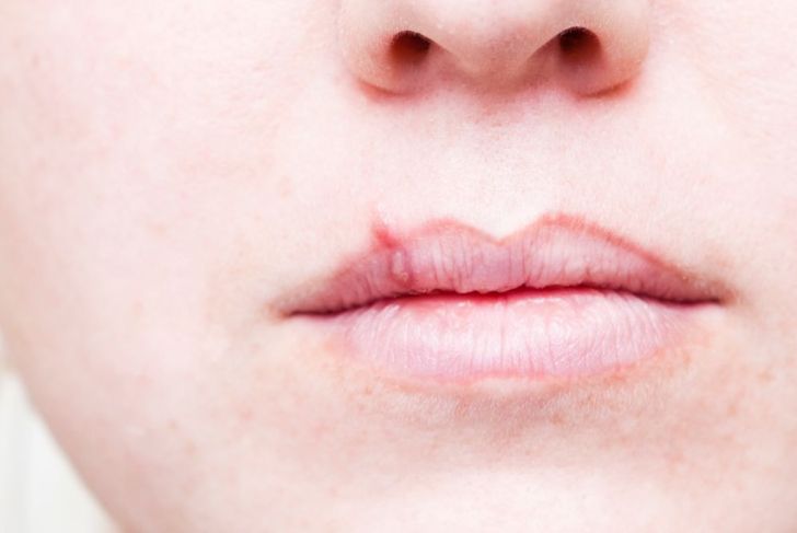 The Stages of a Cold Sore