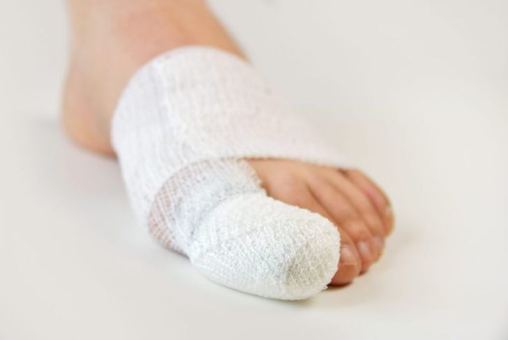 Things to Know About Broken Toes