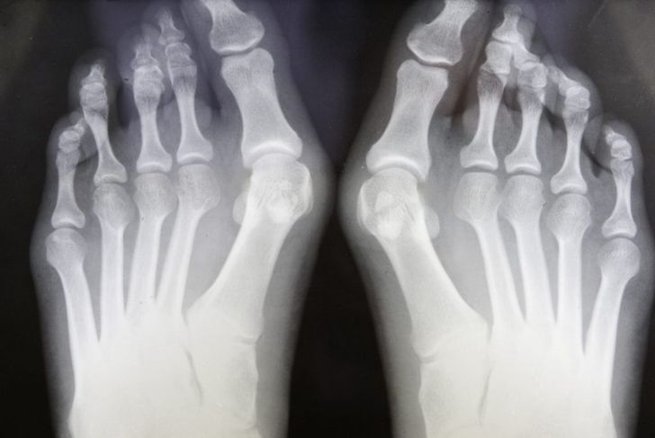 Things to Know About Bunions