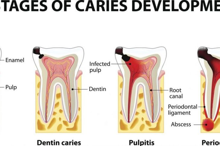 Tooth Abscess: Types, Causes, Complications