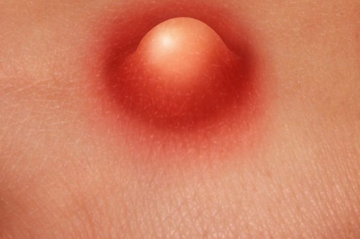 Top Causes of Boils