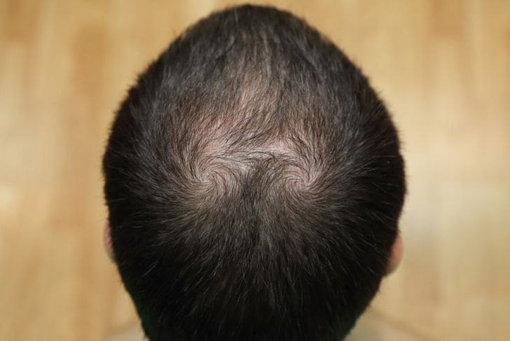 Top Causes of Hair Loss in Men