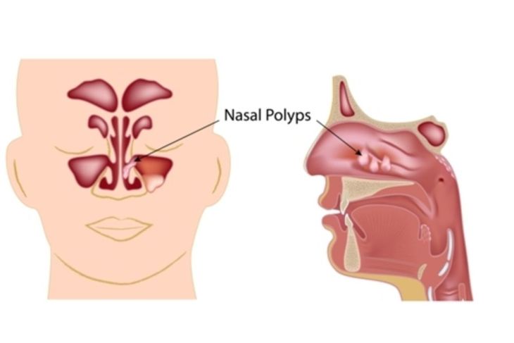 Traditional and Home Remedies For Nasal Polyps