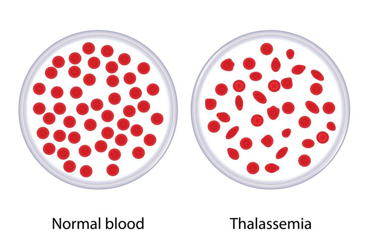 Types of Microcytic Anemia