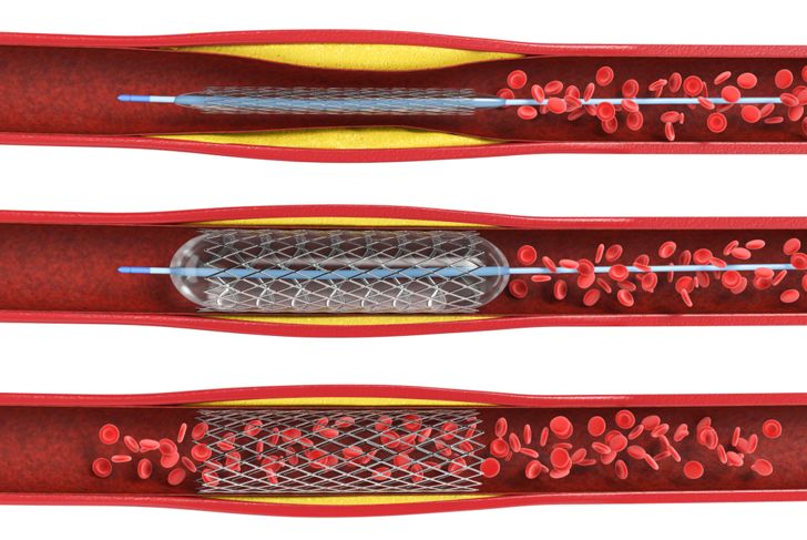 Types of Stents and Their Purposes