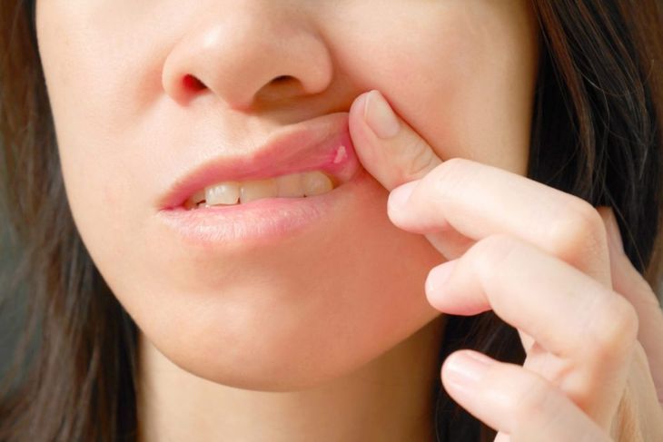 Types of Stomatitis and What to Do