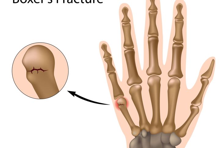 Understanding a Boxer's Fracture of the Hand