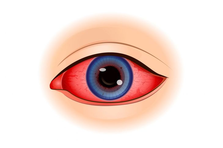 Uveitis is a Serious Eye Disease Masquerading as Minor