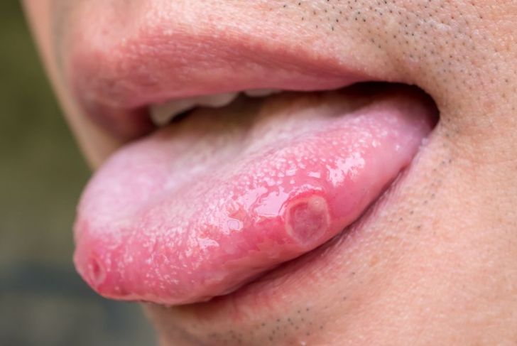 Various Causes of a Sore Tongue