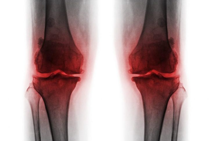 What are Bone Spurs?