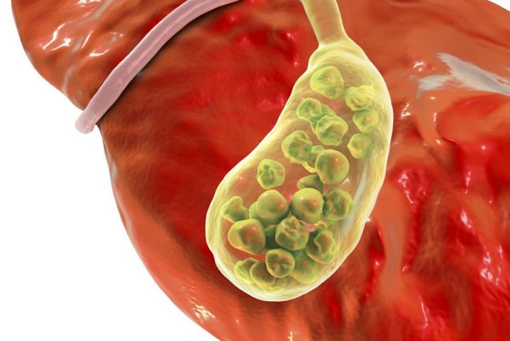 What are Gallstones?